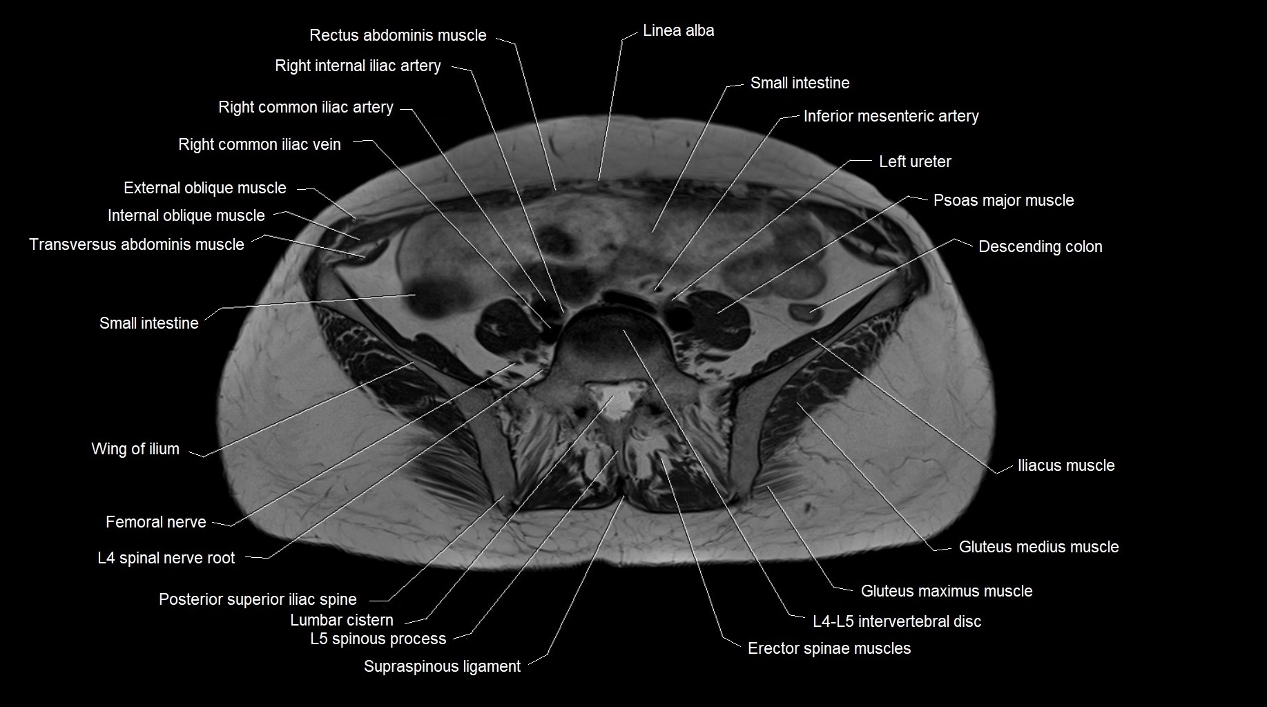 MRI 3T pelvis axial cross section anatomy image 5.webp